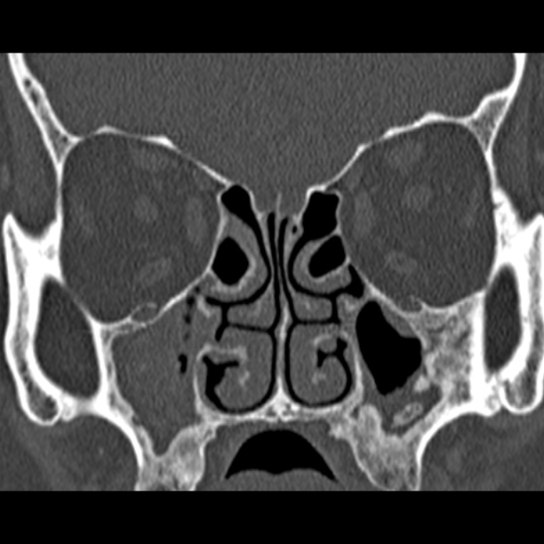 Chronic maxillary sinusitis (Radiopaedia 27879-28116 Coronal bone window 25).jpg