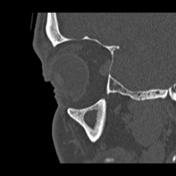 Chronic maxillary sinusitis (Radiopaedia 27879-28116 Sagittal bone window 5).jpg