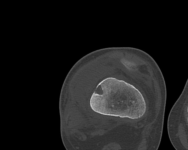 File:Chronic ostemyelitis of the femur with long sinus tract (Radiopaedia 74947-85982 Axial bone window 202).jpg