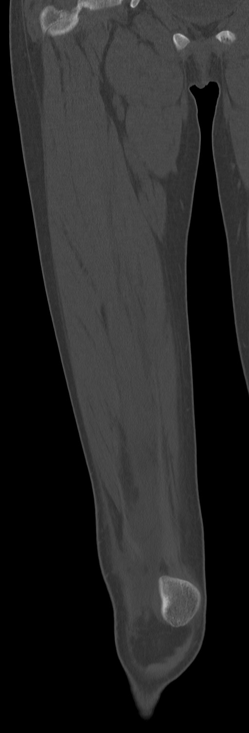 Chronic ostemyelitis of the femur with long sinus tract (Radiopaedia 74947-85982 Coronal bone window 29).jpg