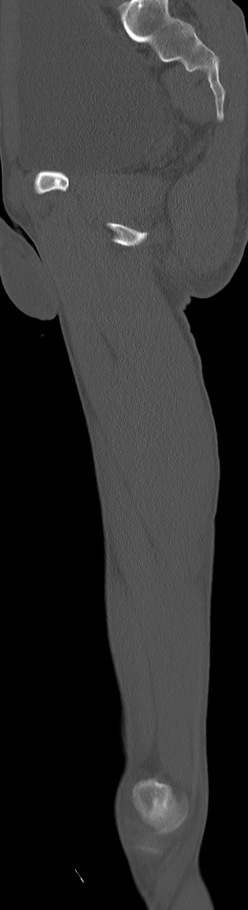 Chronic osteomyelitis (with sequestrum) (Radiopaedia 74813-85822 C 47).jpg