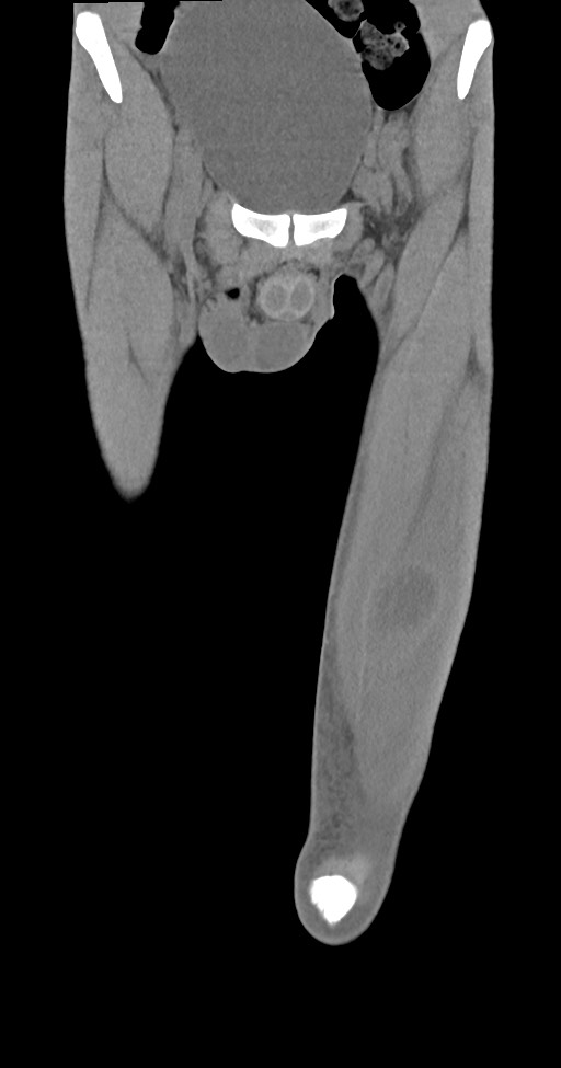 Chronic osteomyelitis (with sequestrum) (Radiopaedia 74813-85822 E 9).jpg