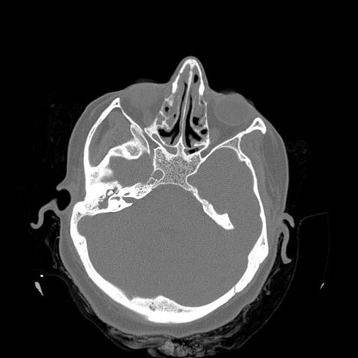 File:Chronic sinusitis with intra-sinus calcification (Radiopaedia 63919-72668 Axial bone window 25).jpg