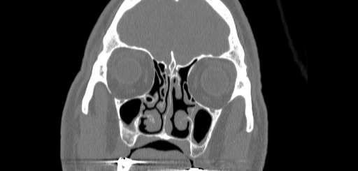 Chronic sphenoidal sinusitis (Radiopaedia 62030-70122 Coronal bone window 53).jpg
