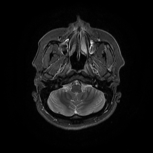 File:Chronic submandibular sialadenitis (Radiopaedia 61852-69885 Axial STIR 5).jpg