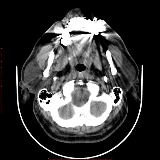 Chronic submandibular sialolithiasis (Radiopaedia 69817-79814 Axial non-contrast 47).jpg
