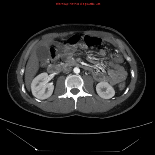 File:Circumaortic left renal vein (Radiopaedia 9069-9792 A 24).jpg