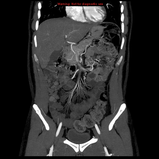 File:Circumaortic left renal vein (Radiopaedia 9069-9792 B 8).jpg