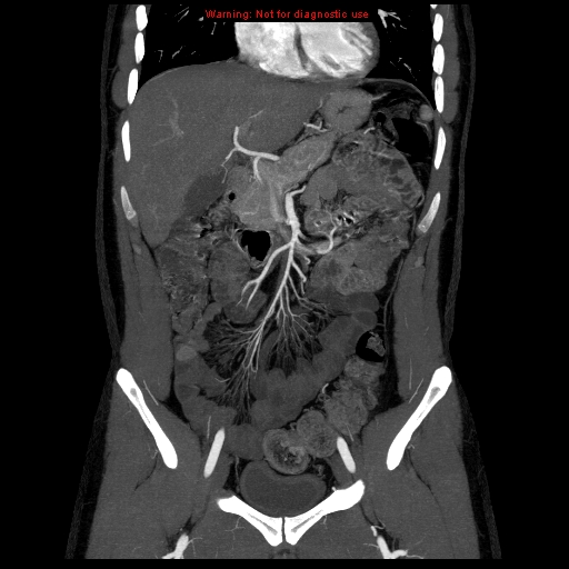 File:Circumaortic left renal vein (Radiopaedia 9069-9792 B 9).jpg