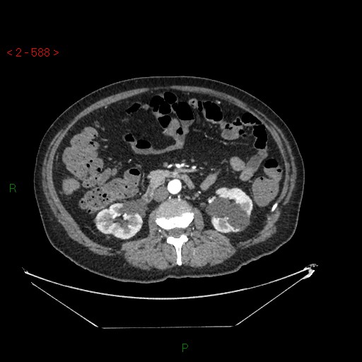 Circumaortic left renal vein and doubled left renal arteries (Radiopaedia 52268-58158 A 124).jpg