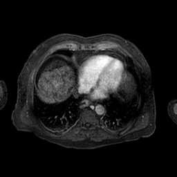 Cirrhosis and hepatocellular carcinoma in the setting of hemochromatosis (Radiopaedia 75394-86594 Axial T1 C+ fat sat 248).jpg