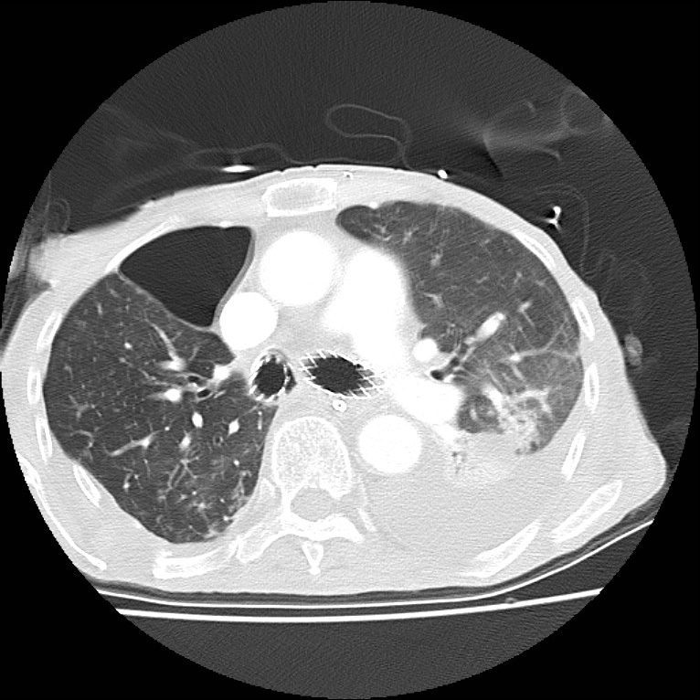 Clagett thoracotomy with bronchopleural fistula (Radiopaedia 29192-29587 Axial lung window 21).jpg