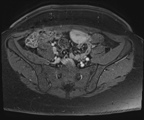 File:Class II Mullerian duct anomaly- unicornuate uterus with rudimentary horn and non-communicating cavity (Radiopaedia 39441-41755 Axial T1 fat sat 9).jpg