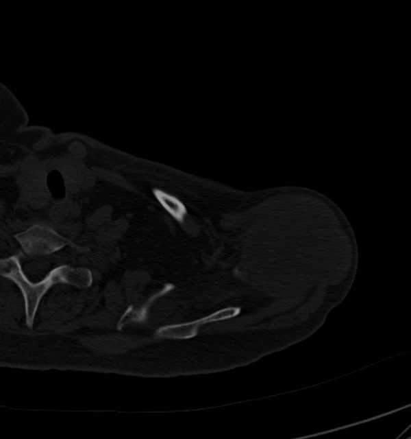 Clear cell chondrosarcoma - humerus (Radiopaedia 63104-71612 Axial bone window 19).jpg