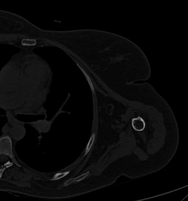 Clear cell chondrosarcoma - humerus (Radiopaedia 63104-71612 Axial bone window 78).jpg
