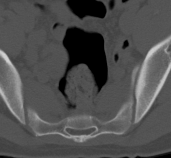 Clear cell meningoma - lumbar spine (Radiopaedia 60116-67691 Axial bone window 82).png