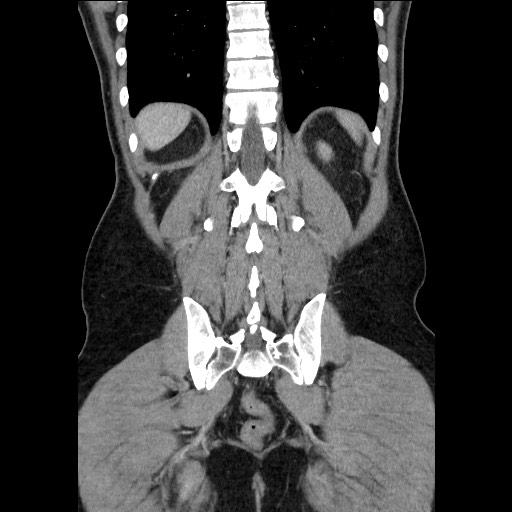 Closed-loop small bowel obstruction (Radiopaedia 73713-84509 C 99).jpg