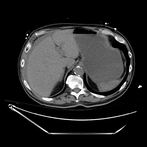 Closed loop obstruction due to adhesive band, resulting in small bowel ischemia and resection (Radiopaedia 83835-99023 Axial non-contrast 34).jpg