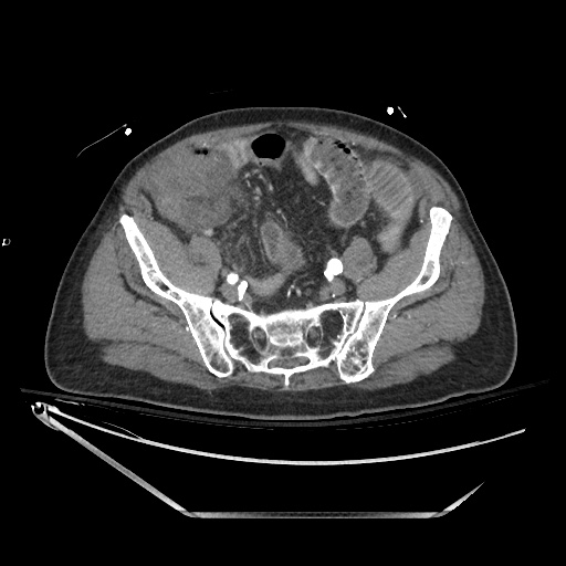 Closed loop obstruction due to adhesive band, resulting in small bowel ischemia and resection (Radiopaedia 83835-99023 B 116).jpg