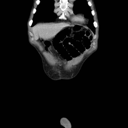 File:Closed loop small bowel obstruction (Radiopaedia 59227-66554 B 8).jpg