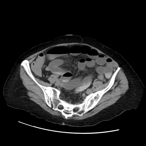 File:Closed loop small bowel obstruction due to adhesive band, with intramural hemorrhage and ischemia (Radiopaedia 83831-99017 Axial non-contrast 118).jpg