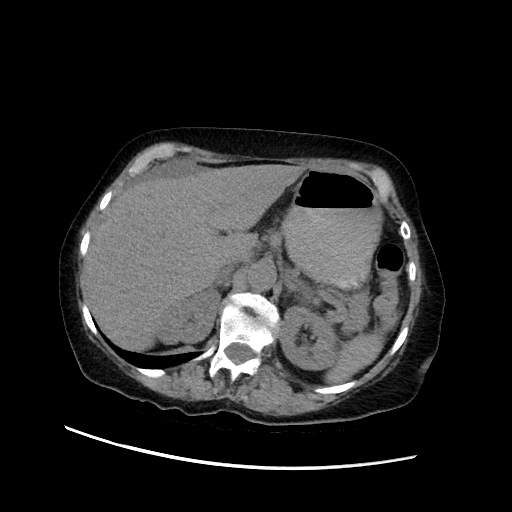 Closed loop small bowel obstruction due to adhesive band, with intramural hemorrhage and ischemia (Radiopaedia 83831-99017 Axial non-contrast 47).jpg