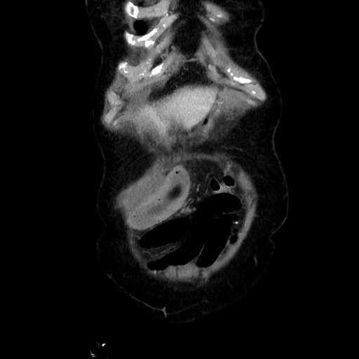 File:Closed loop small bowel obstruction due to adhesive band, with intramural hemorrhage and ischemia (Radiopaedia 83831-99017 C 21).jpg
