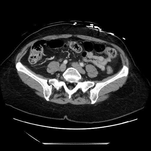 File:Closed loop small bowel obstruction due to adhesive bands - early and late images (Radiopaedia 83830-99014 A 101).jpg