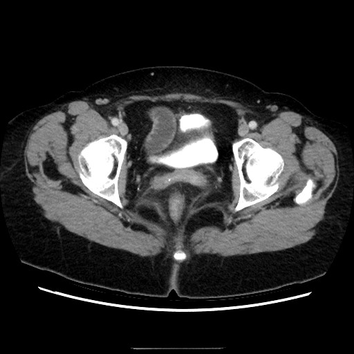Closed loop small bowel obstruction due to adhesive bands - early and late images (Radiopaedia 83830-99015 A 157).jpg