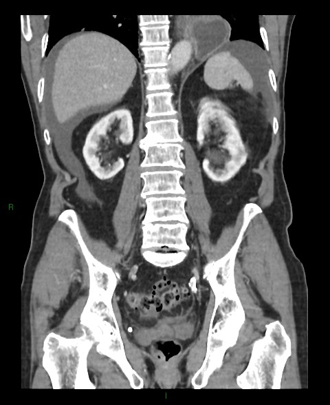 Closed loop small bowel obstruction with ischemia (Radiopaedia 84180-99456 B 22).jpg