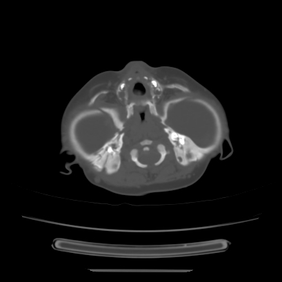 Cloverleaf skull (Radiopaedia 91901-109710 Axial bone window 43).jpg