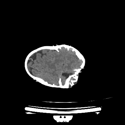 Cloverleaf skull (Radiopaedia 91901-109710 Axial non-contrast 126).jpg