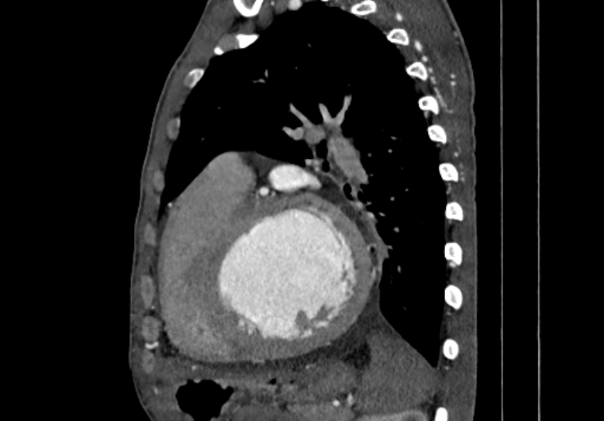 Coarctation of aorta with aortic valve stenosis (Radiopaedia 70463-80574 B 128).jpg