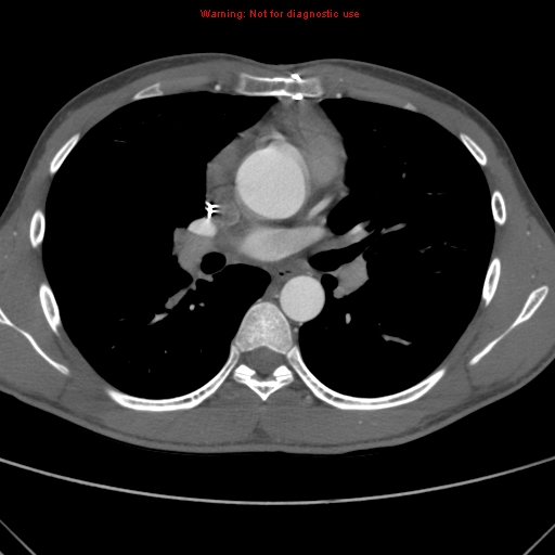 File:Coarctation of the aorta (Radiopaedia 9434-10118 A 90).jpg