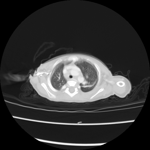 Coarctation of the aorta and patent ductus arteriosus (Radiopaedia 68033-77499 Axial lung window 8).jpg