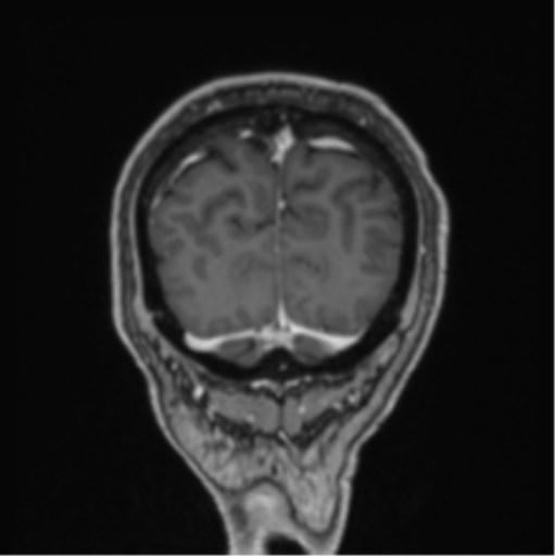 File:Colloid cyst of the third ventricle (Radiopaedia 86571-102662 Coronal T1 C+ 15).png