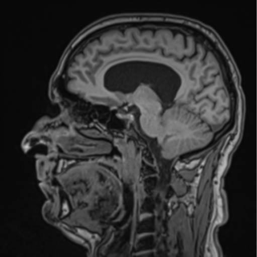 File:Colloid cyst of the third ventricle (Radiopaedia 86571-102662 Sagittal T1 44).png