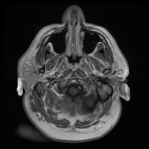 File:Colloid cyst with anterior communicating artery aneurysm (Radiopaedia 33901-35091 Axial T1 3).jpg