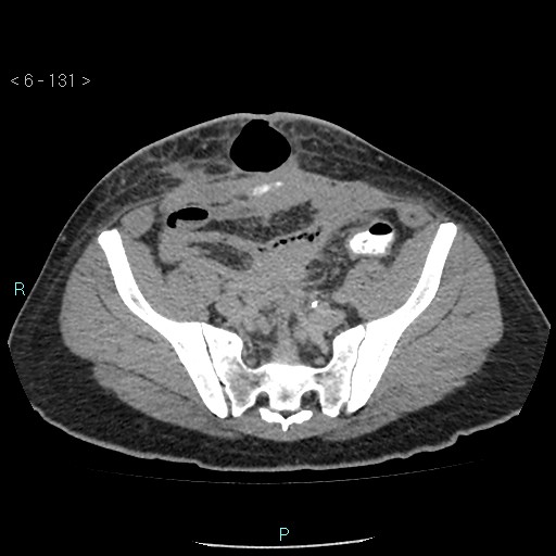 File:Colo-cutaneous fistula (Radiopaedia 40531-43129 A 54).jpg
