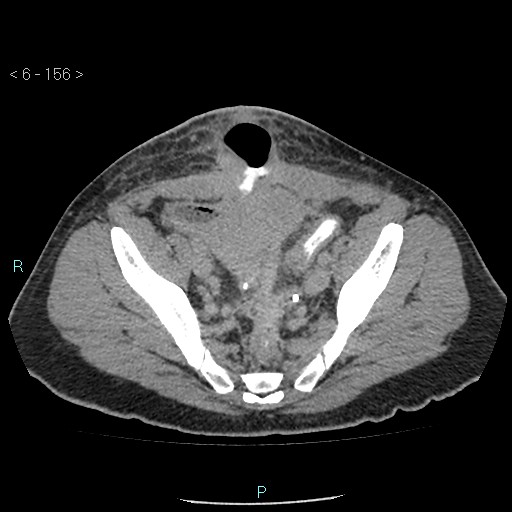 File:Colo-cutaneous fistula (Radiopaedia 40531-43129 A 65).jpg