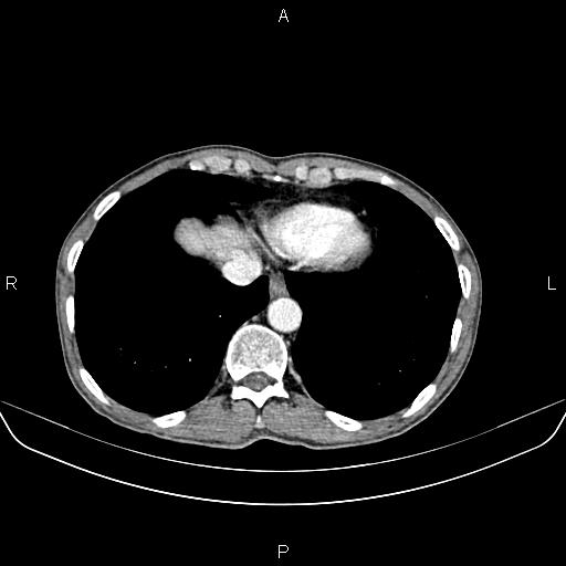 Colon adenocarcinoma - hepatic flexure (Radiopaedia 85635-101395 A 10).jpg