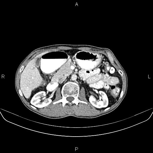 File:Colon adenocarcinoma - hepatic flexure (Radiopaedia 85635-101395 A 33).jpg