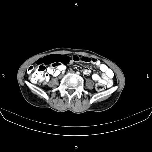 Colon adenocarcinoma - hepatic flexure (Radiopaedia 85635-101395 A 59).jpg
