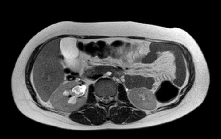 Colon adenocarcinoma with Krukenberg tumors, advanced pregnancy (Radiopaedia 67279-76645 Axial T2 50).jpg