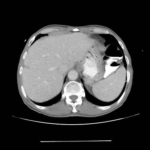 Colon cancer with calcified liver metastasis (Radiopaedia 74423-85307 A 15).jpg
