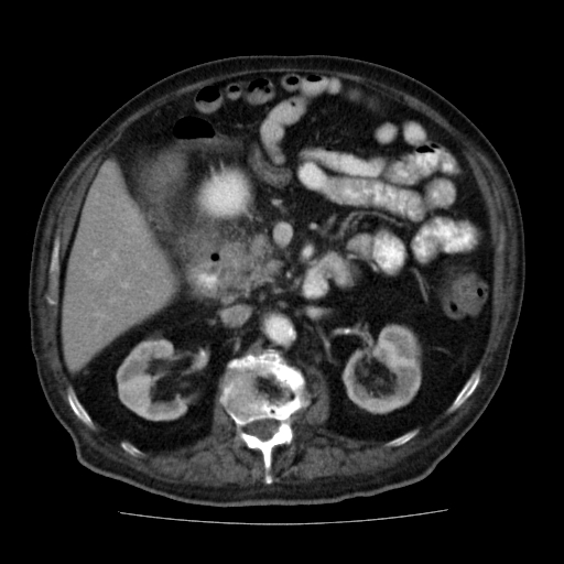 File:Colon cancer with duodenal invasion (Radiopaedia 16278-15958 A 23).jpg