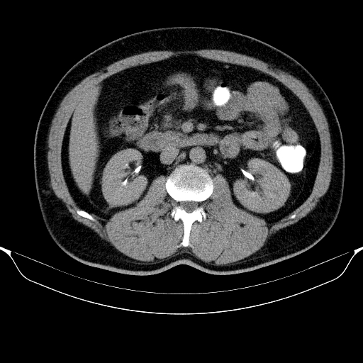 Colonic lipoma with colo-colic intussusception (Radiopaedia 58944-66200 Axial C+ rectal 26).jpg