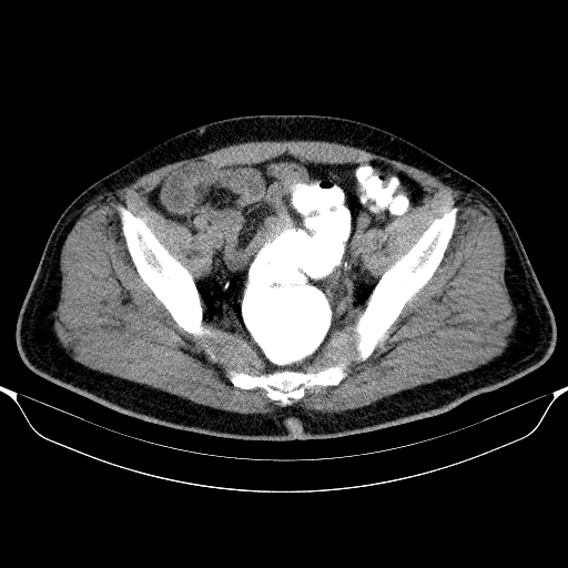File:Colonic lipoma with colo-colic intussusception (Radiopaedia 58944-66200 Axial C+ rectal 60).jpg