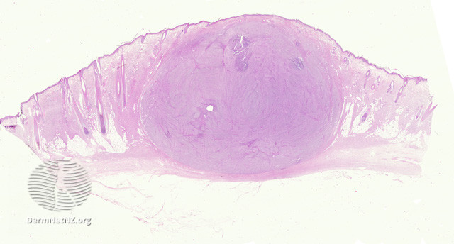 File:Figure 1 (DermNet NZ pathology-e-fibrosarcoma-figure-1).jpg
