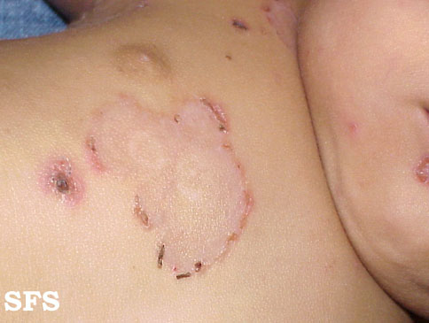 File:Impetigo (Dermatology Atlas 23).jpg